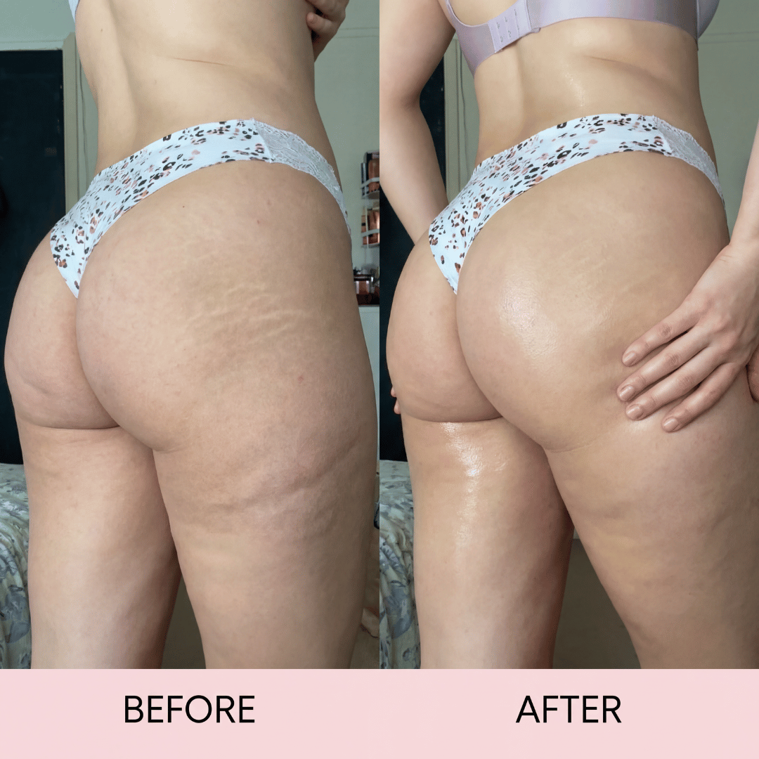 Milow Beauty™ Premium Anti-Cellulite Oil