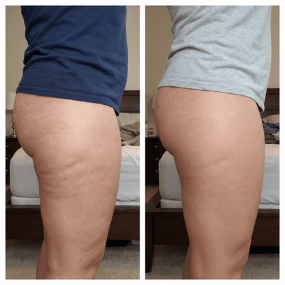 Milow Beauty™ Premium Anti-Cellulite Oil